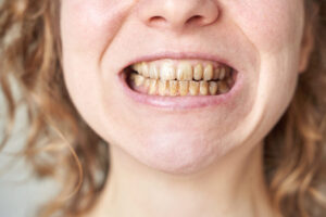 Female Caucasian adult teeth with plaque and tartar close up dental hygiene problem
